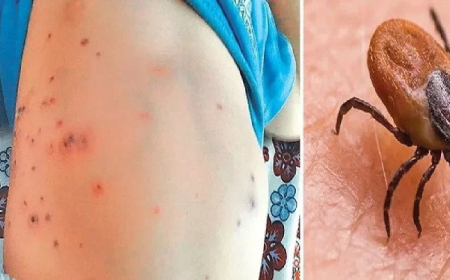 ବଢୁଛି ସ୍କର୍ବ ଟାଇଫସ୍‌ ଆତଙ୍କ